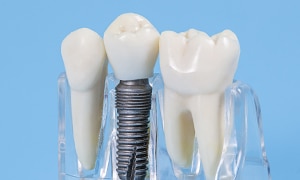 implantes dentales en medellin